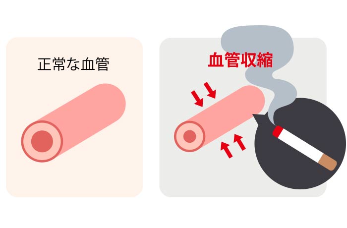 タバコは血管と歯周病に悪影響