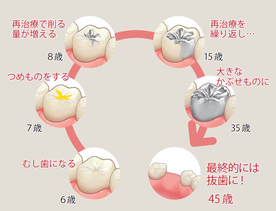 リピートレストレーションサイクル