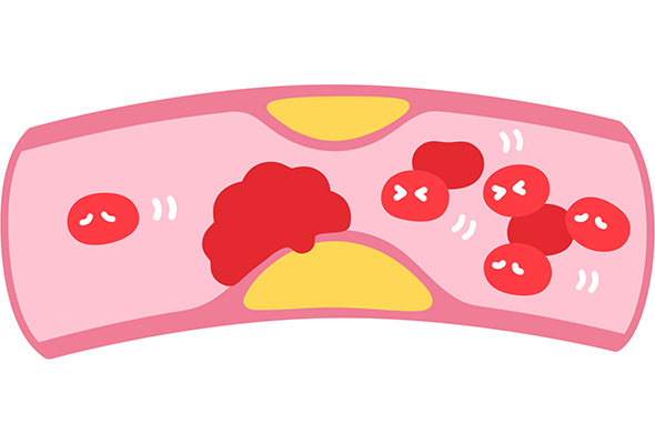 血管の断面図で、血栓があるため血がうまく流れない状態のイラスト