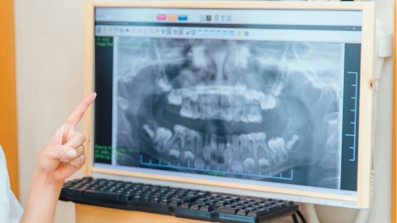 歯科用レントゲンを指差している